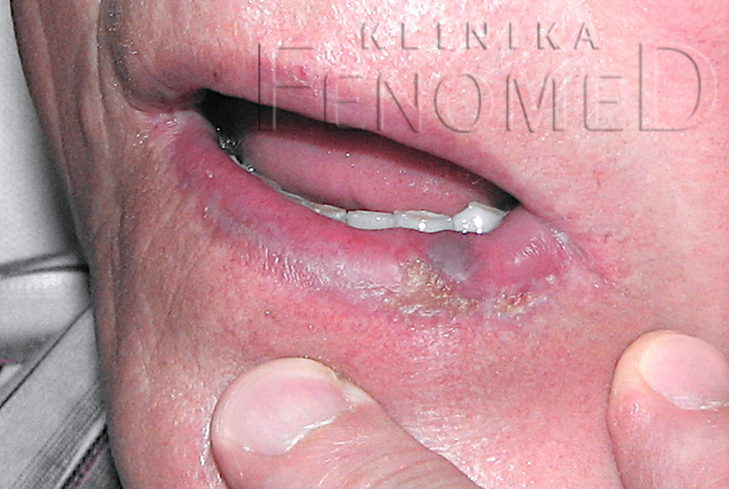 Rogowacenie słoneczne