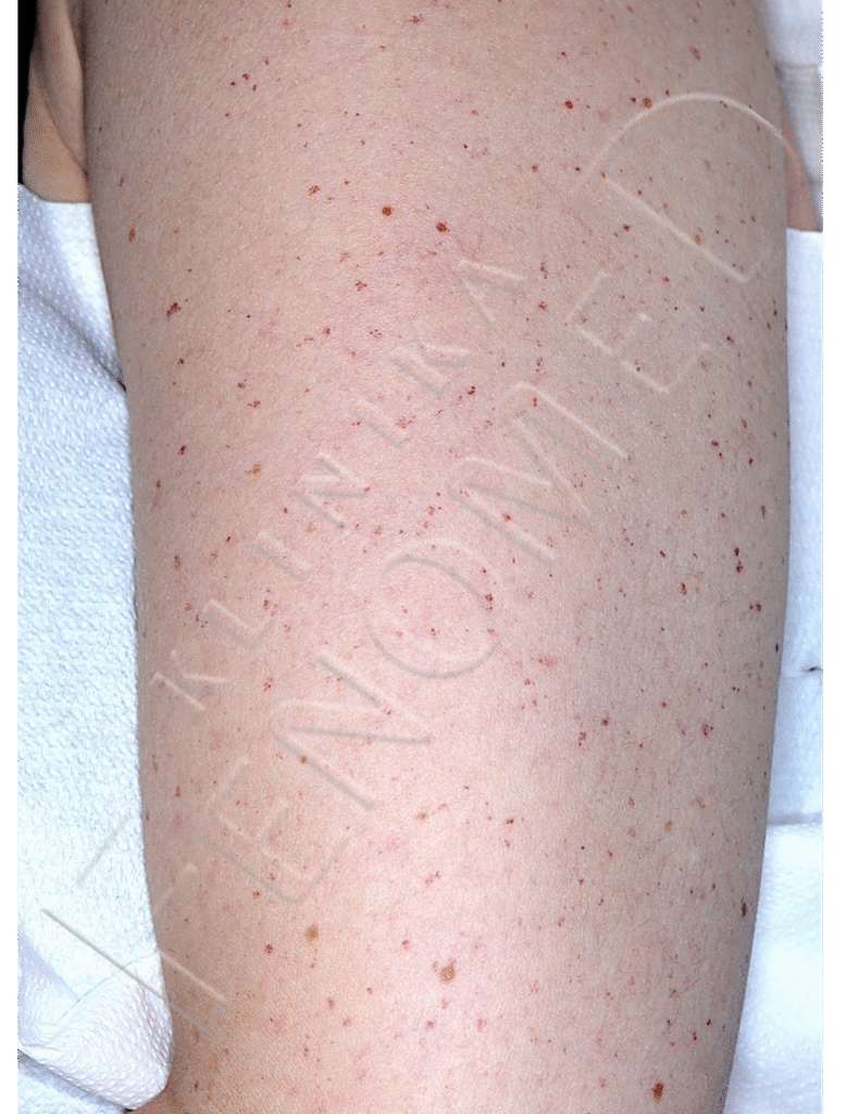 Choroba Rendu-Oslera-Webera