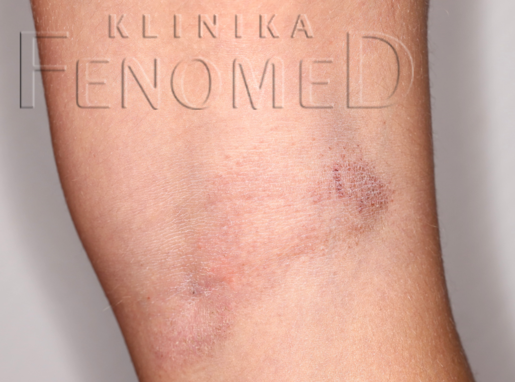 Atopowe zapalenie skóry (dermatitis atopica)