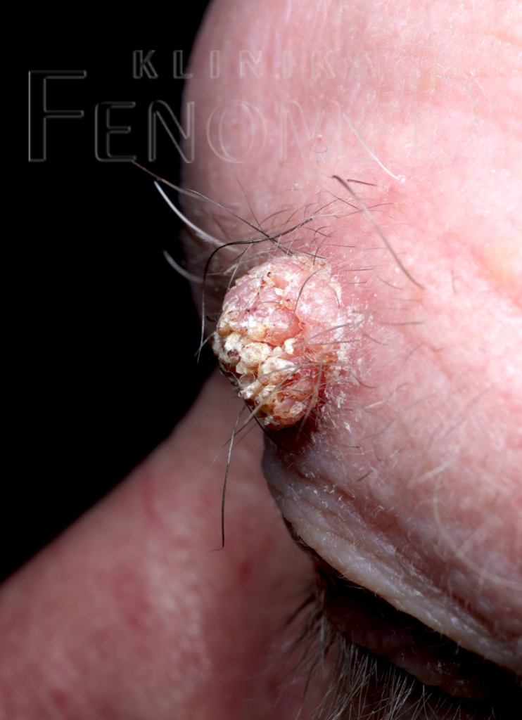 Brodawka łojotokowa na skórze brwi