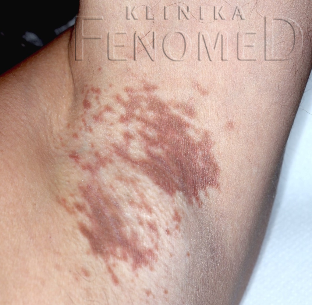 Choroba Haileya-Haileya