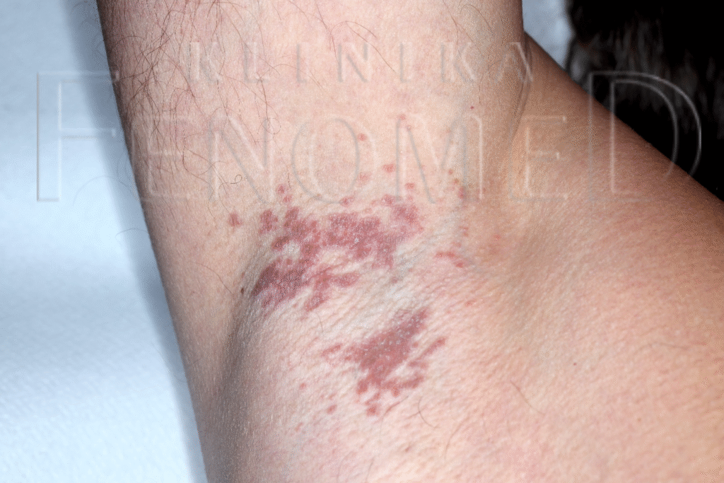 choroba-haileya-haileya