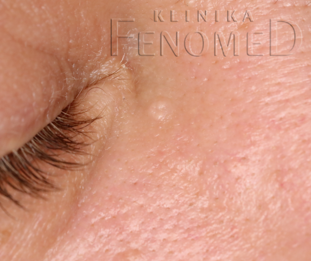 Hiperplazja gruczołów łojowych