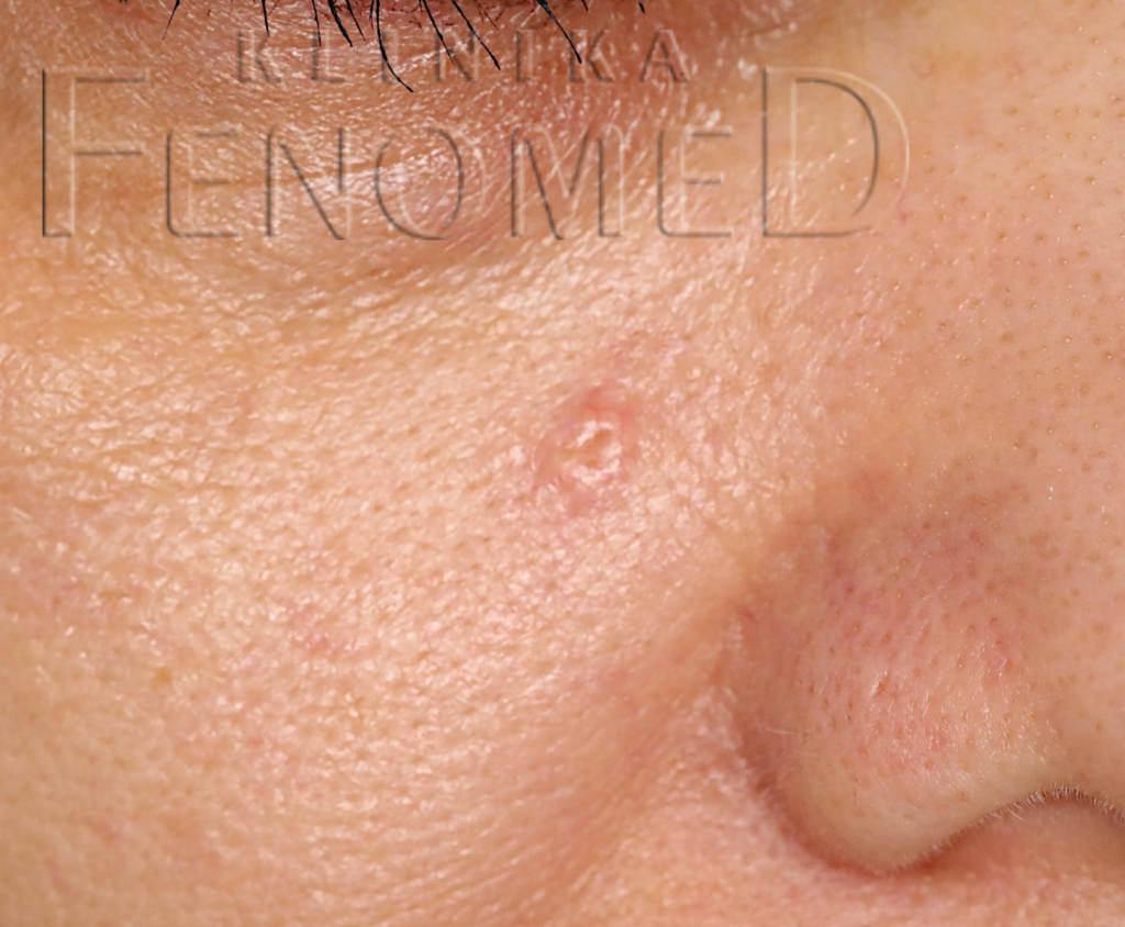 Hiperplazja gruczołów łojowych (sebaceous hyperplasia)