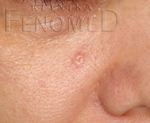 Hiperplazja gruczołów łojowych (sebaceous hyperplasia)