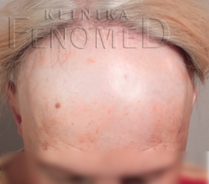 Liszaj płaski mieszkowy