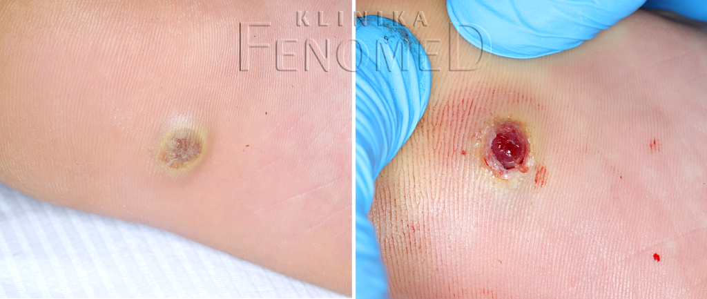 Ziarniniak naczyniowy