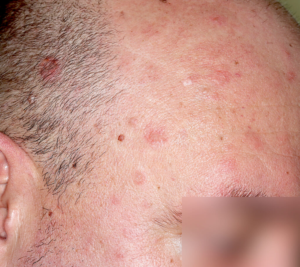 pęcherzyca liściasta