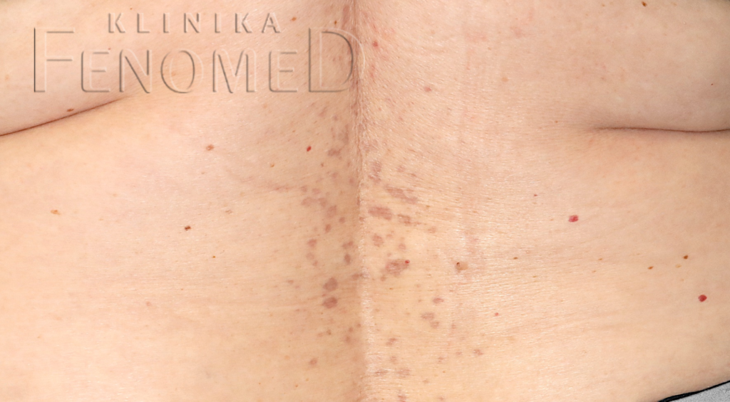 Liszaj płaski na skórze grzbietu