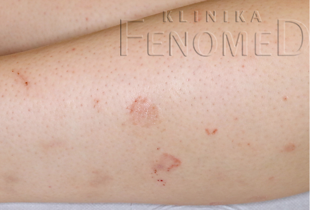 Pityriasis lichenoides subacuta