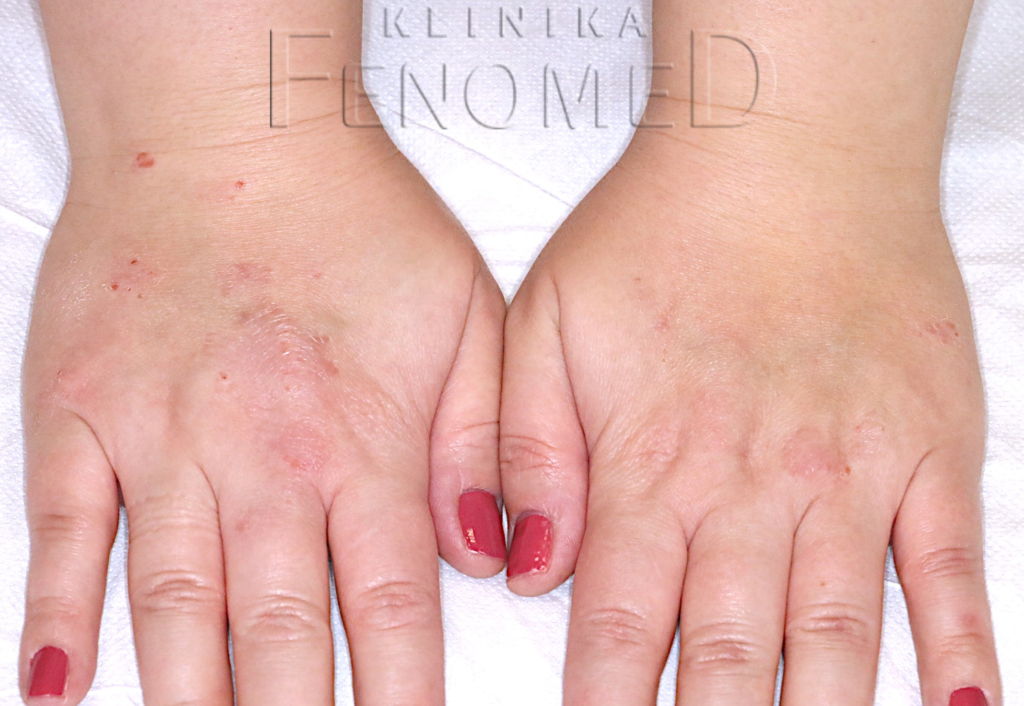 Pityriasis lichenoides subacuta (2)