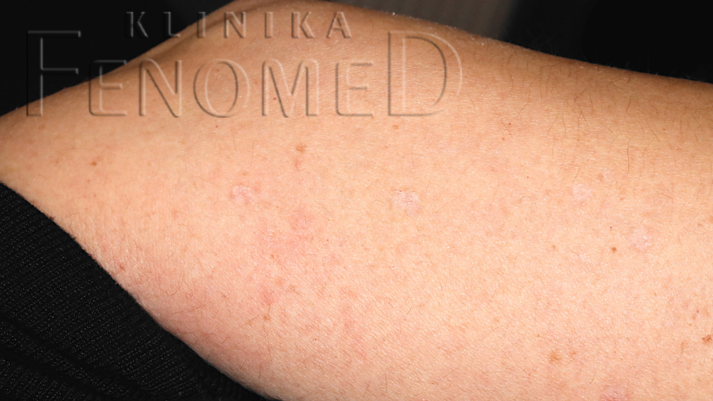 Rozsiana porokeratoza słoneczna