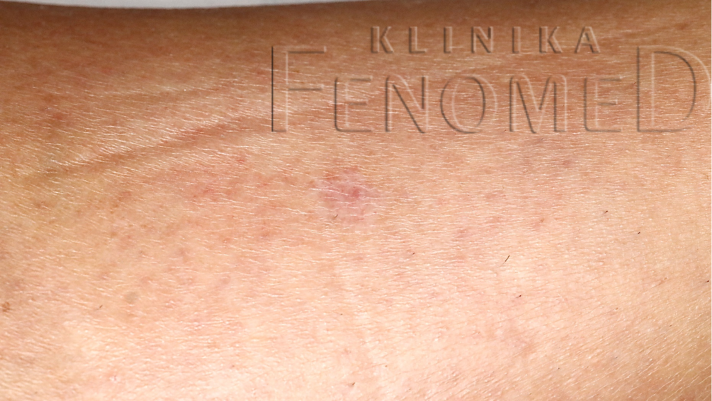 Rozsiana porokeratoza słoneczna