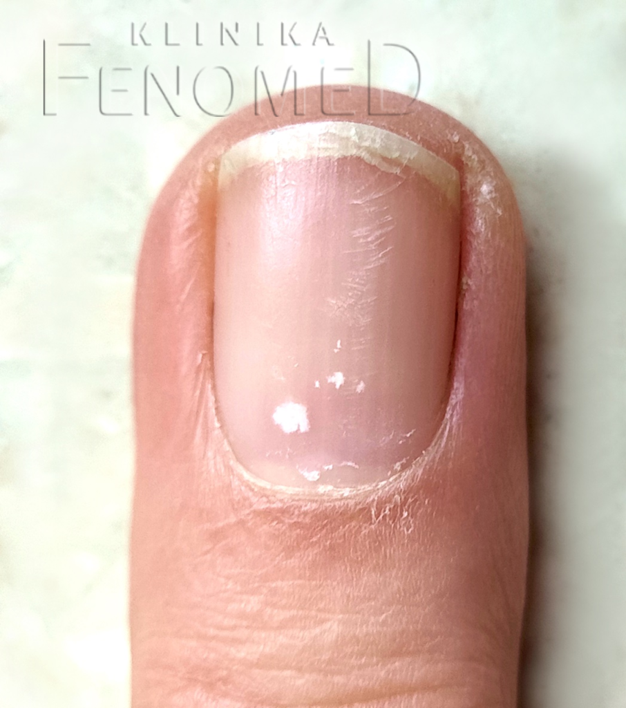 białe plamki na paznokciach