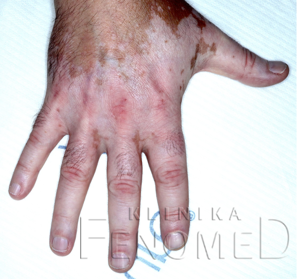 Bielactwo (Vitiligo)