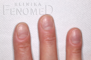 Bruzdy na paznokciach (Onychorrhexis)