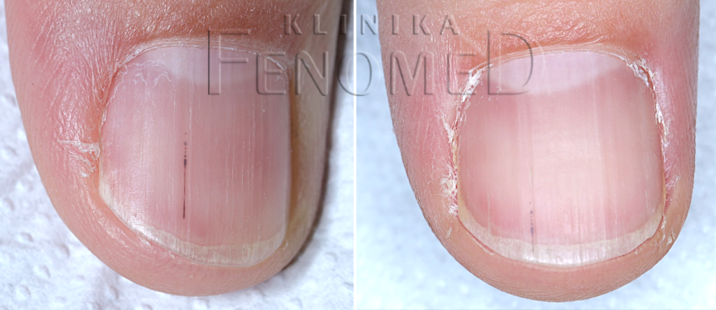 czarna smuga pod paznokciem