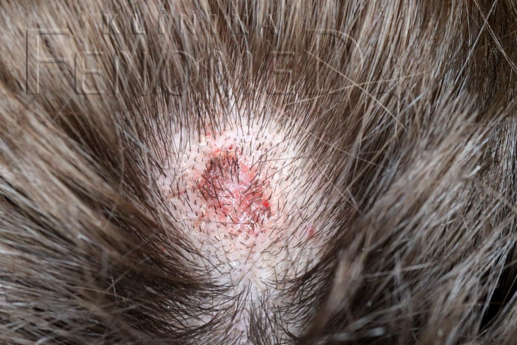 Dermatitis artefacta