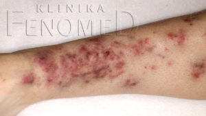 Grzybica (mycosis)