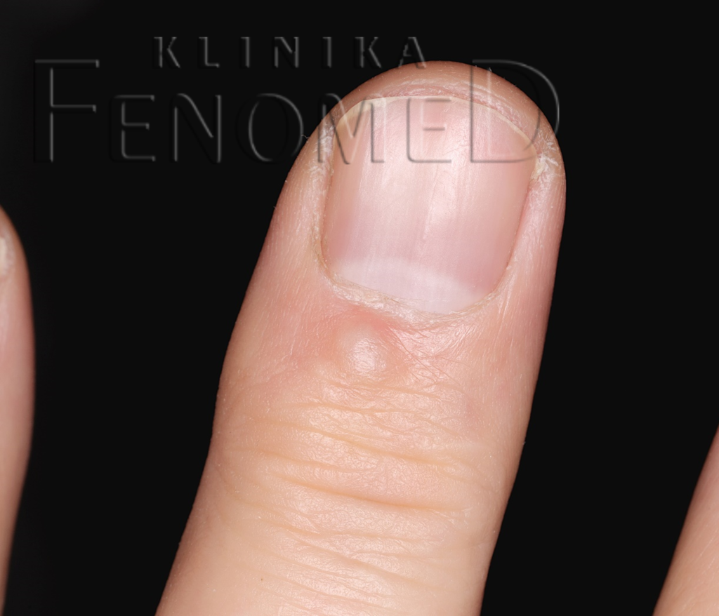 Torbiel śluzowa okołopaznokciowa