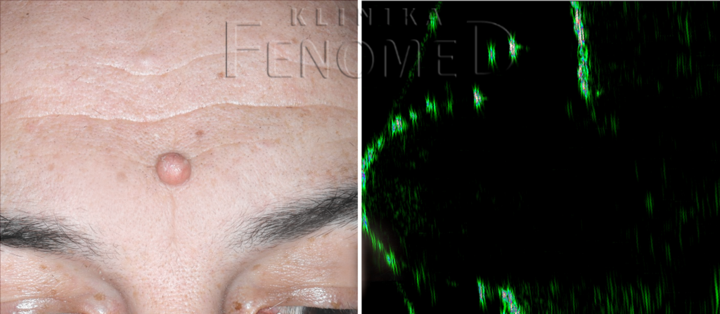 juvenile xanthogranuloma