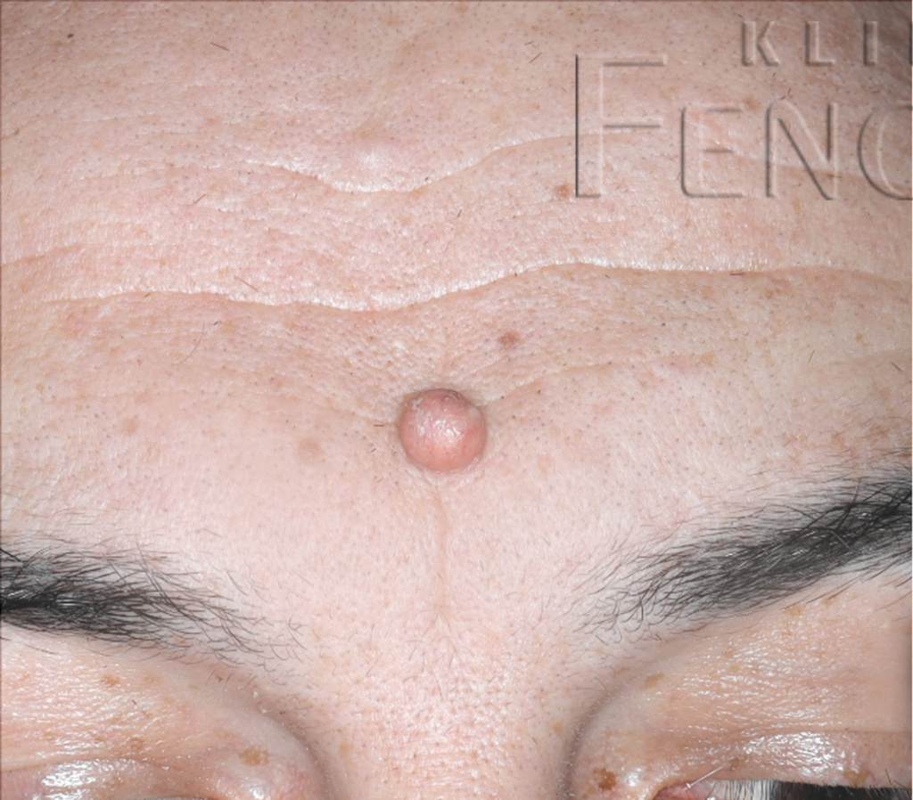 Juvenile xanthogranuloma