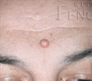 Juvenile xanthogranuloma