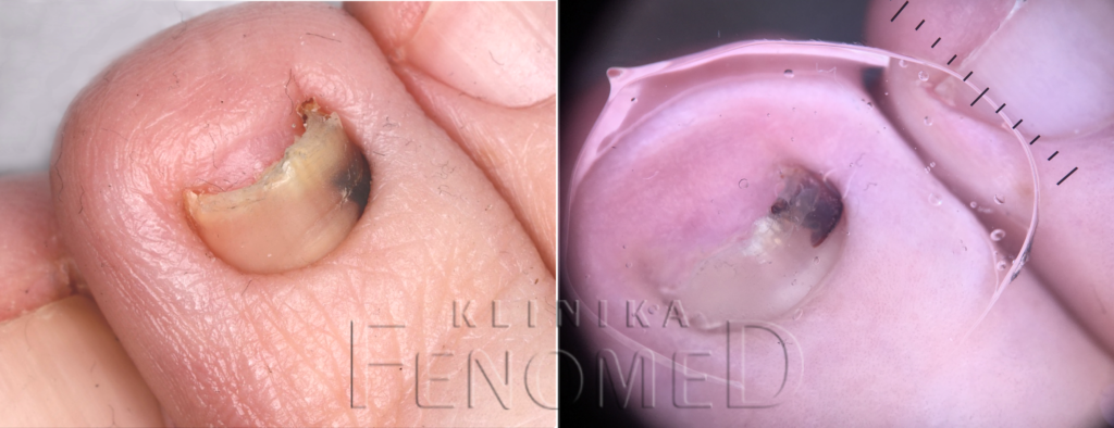 Krwiak podpaznokciowy