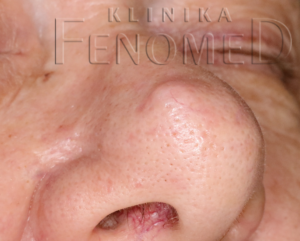 Nerwiakowłókniak myksoidny