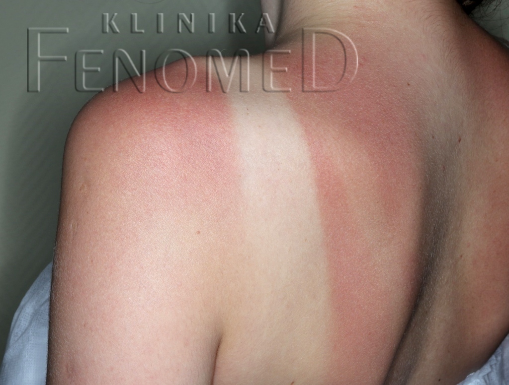 Oparzenie słoneczne