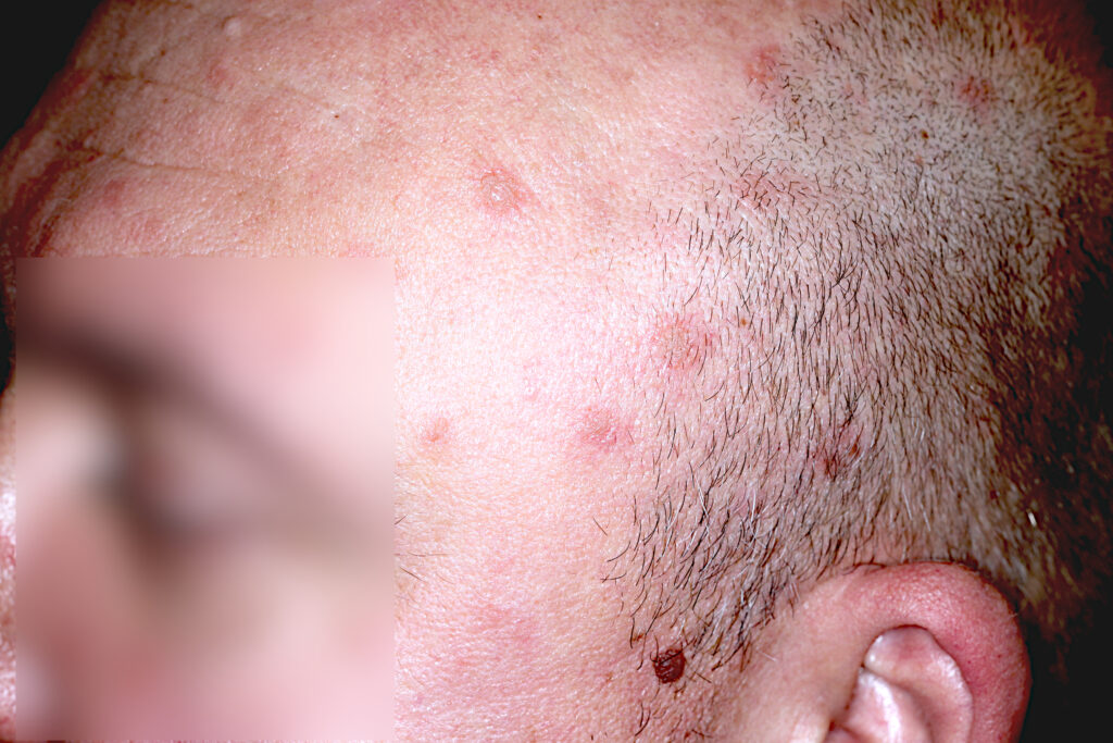 Pęcherzyca liściasta