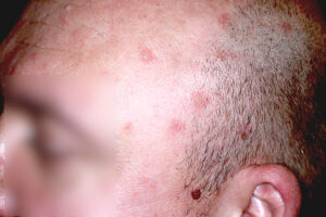 Pęcherzyca liściasta