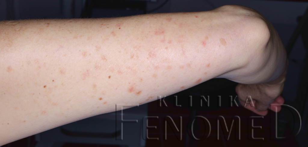 Rozsiana porokeratoza słoneczna