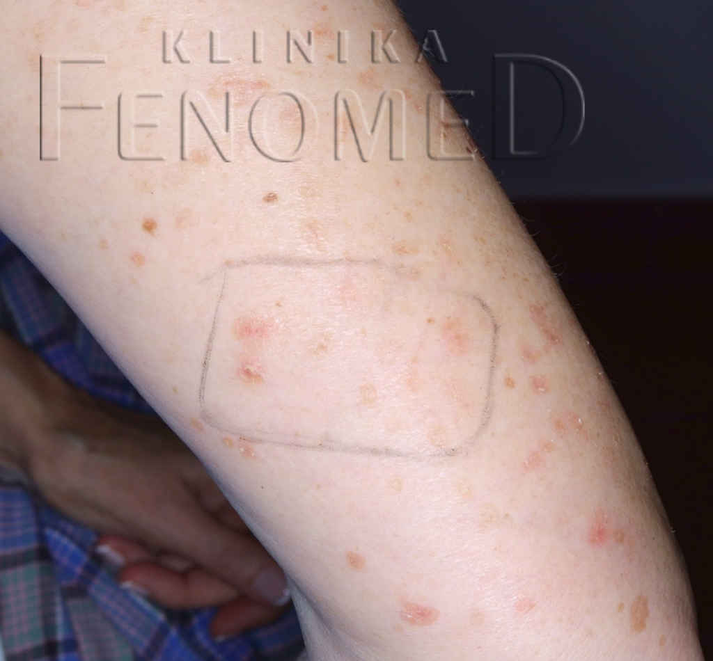 Rozsiana porokeratoza słoneczna