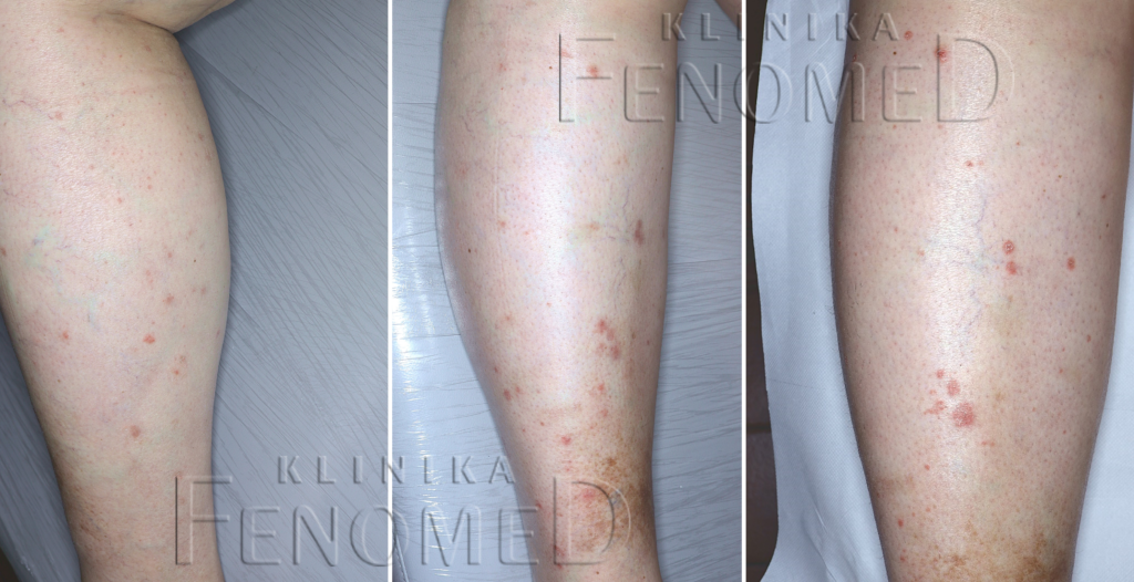 Przyłuszczyca grudkowa