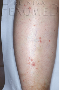 Przyłuszczyca grudkowa