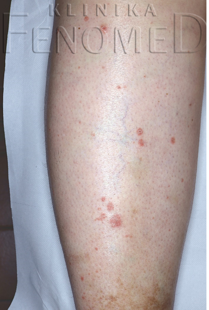 Przyłuszczyca grudkowa