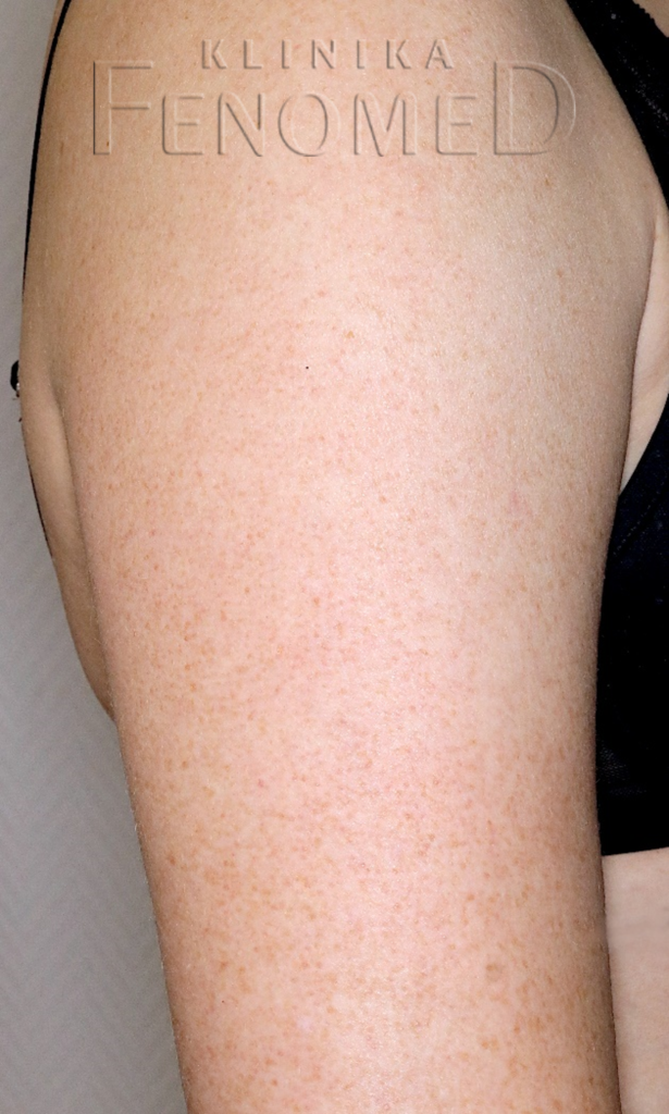 rogowacenie mieszkowe