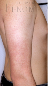 Rogowacenie mieszkowe