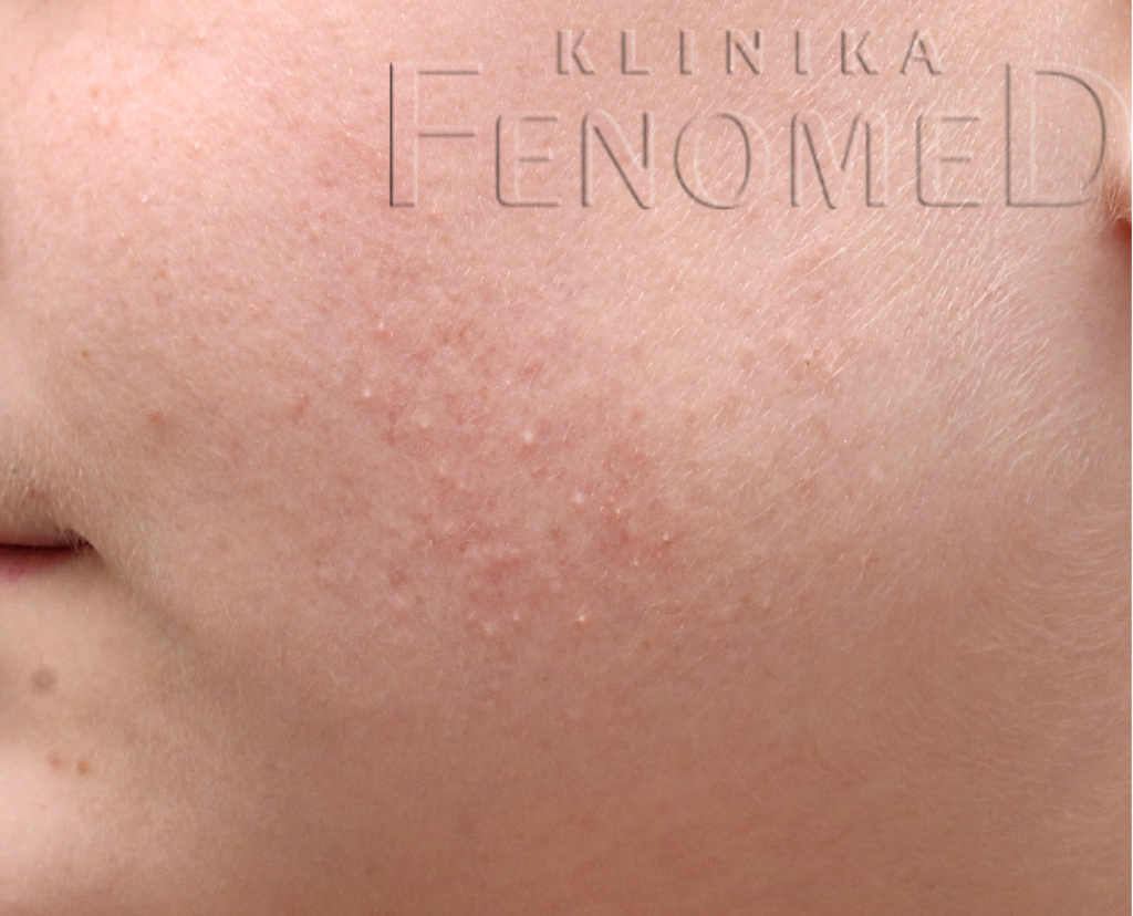 rogowacenie mieszkowe twarz