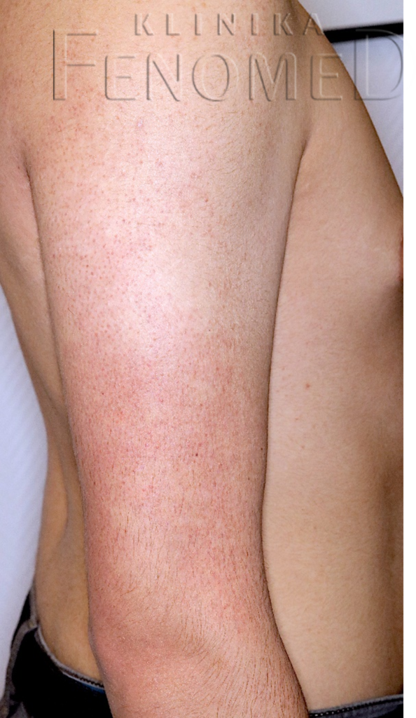 Rogowacenie mieszkowe