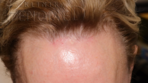 Toczeń rumieniowaty krążkowy