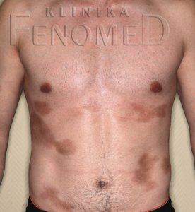 Twardzina ograniczona