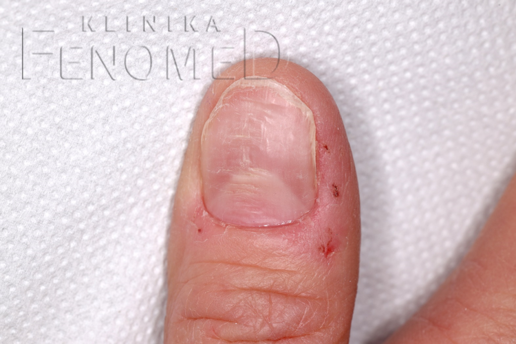 Uszkodzenie płytki paznokcia