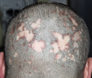 Wyłysiające zapalenie mieszków włosowych