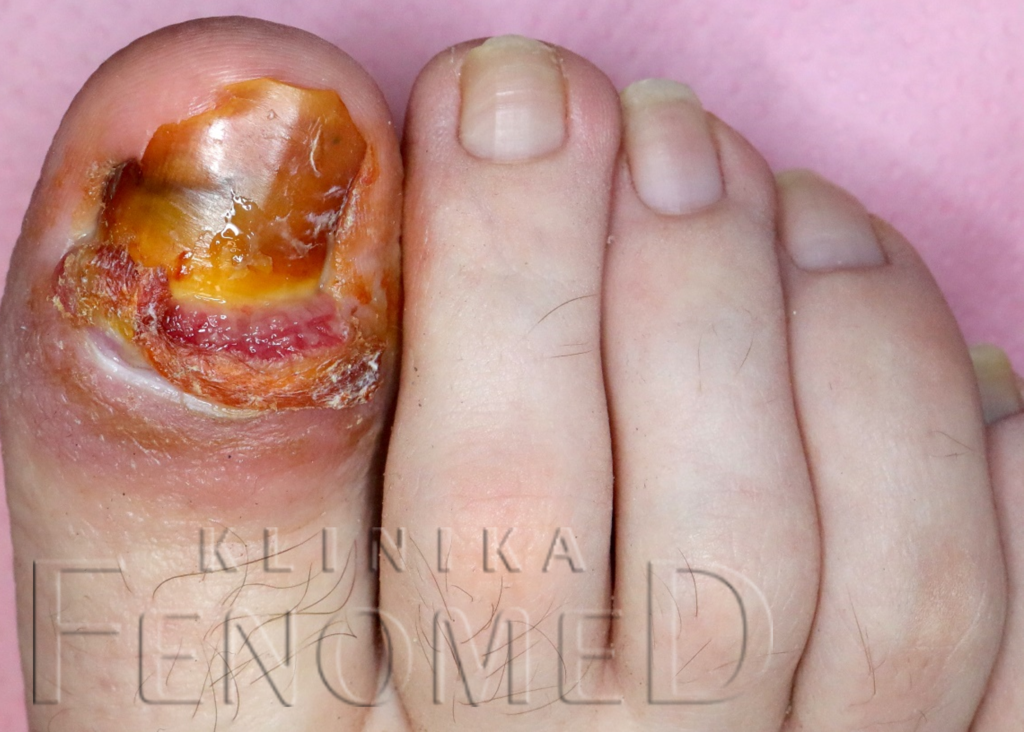 Zakażenie paznokcia