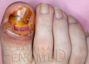 Zakażenie paznokcia