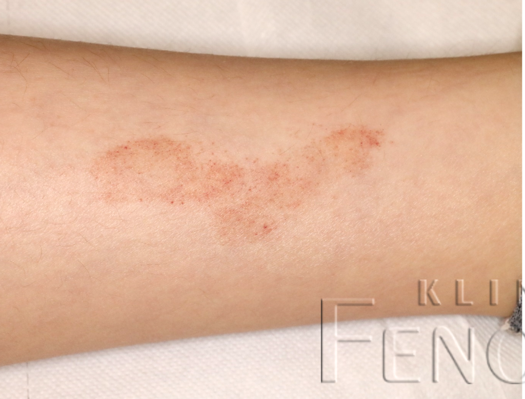 Capillaritis chronica