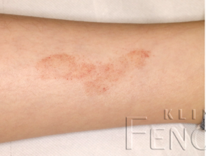 Capillaritis chronica