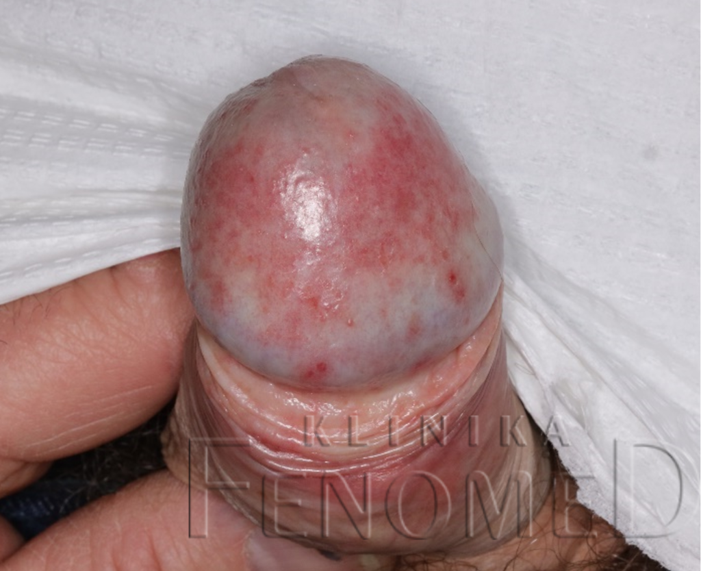 Zapalenie żołędzi